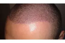 Kök Hücre Saç Ekimi Kullanımı ve Faydaları Nelerdir?